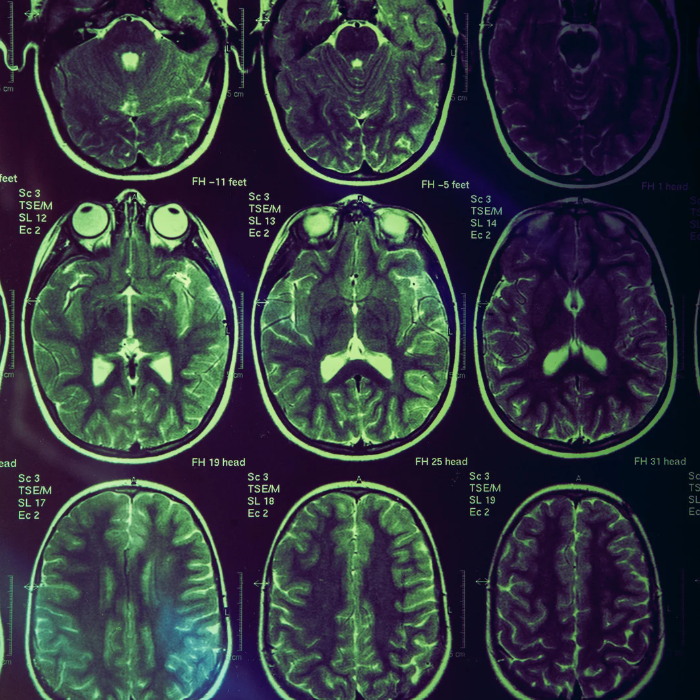 注意障害を呈する患者へのリハビリアプローチ|集中力を引き出す評価と介入のコツ