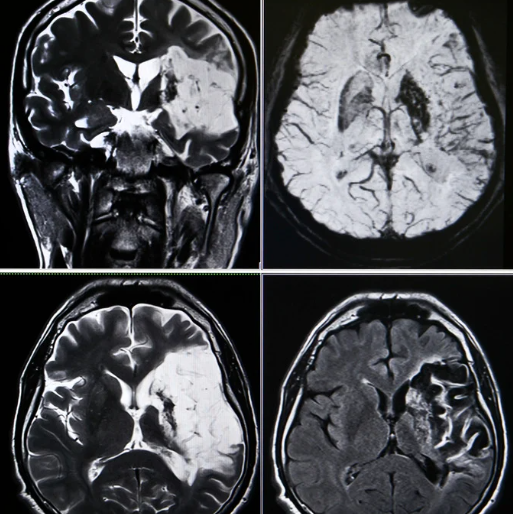 半側空間無視を呈する患者様のリハビリを脳科学的に評価すべき理由とは？