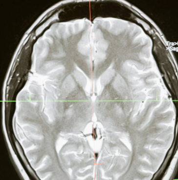 脳血管疾患のリハビリで脳画像を評価すべき理由とは？