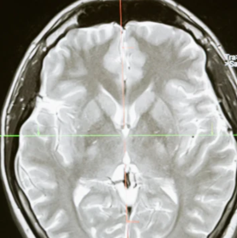 脳血管疾患リハに必須｜脳画像を自分の目で読むPT・OTになるための第一歩