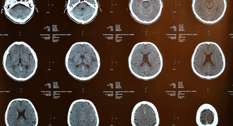 脳科学的視点から学ぶ高次脳機能障害｜一括申込