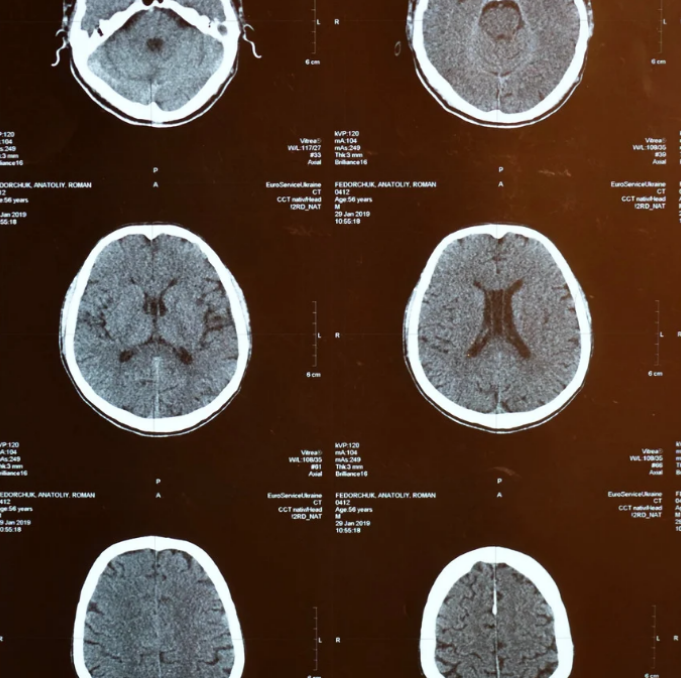 脳科学的視点から学ぶ高次脳機能障害｜全般性注意障害、遂行機能障害編